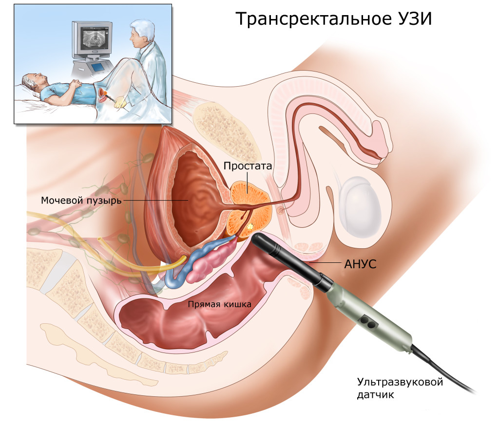 узи простаты как делается